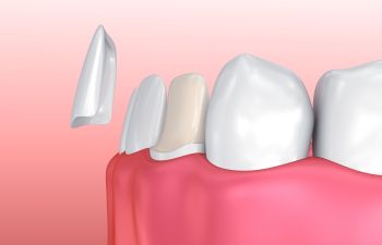 Dental Veneers