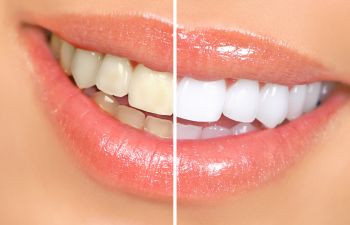 Woman's teeth before and after professional whitening.